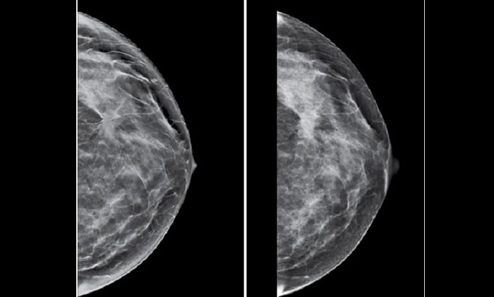Mamografo
