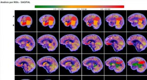 La Salud realiza de forma sistemática estudios cerebrales cuantificados capaces de valorar la evolución de la demencia