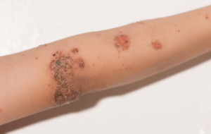 Impétigo en niños: causas y estrategias para prevenir nuevas infecciones