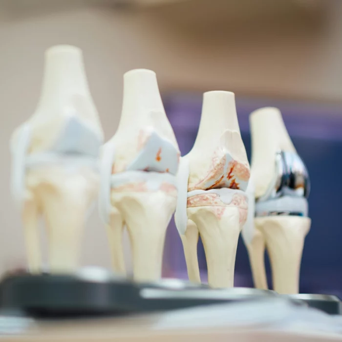 protesis rodilla