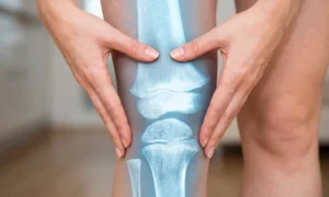 imagen rodilla con prótesis